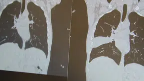 Geçmeyen öksürüğü vardı: Kanser sanıldı, akciğerinden kemik çıktı