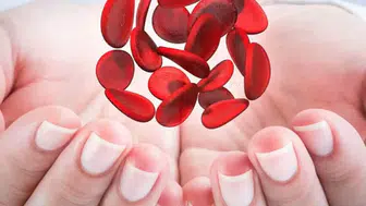 Ferritin yüzü nedir, demir eksikliği dış görünüşten anlaşılır mı?