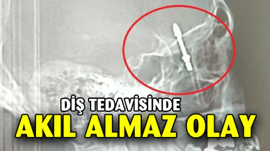 Bursa’da inanılmaz olay: İmplant tedavisinde vida beynine saplandı