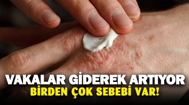Giderek artan egzamanın belirtileri neler?