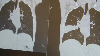 Geçmeyen öksürüğü vardı: Kanser sanıldı, akciğerinden kemik çıktı