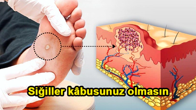 Siğiller kâbusunuz olmasın