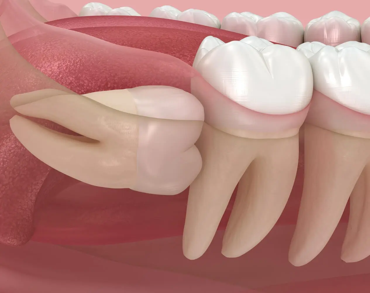 20'lik Diş Ağrısı Neden Olur? Belirtileri ve Çözüm Yolları - Dental Estetik  Center